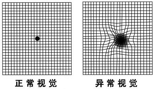 黃斑病變自我檢測表-2